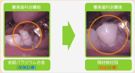 審美歯科治療前→審美歯科治療後